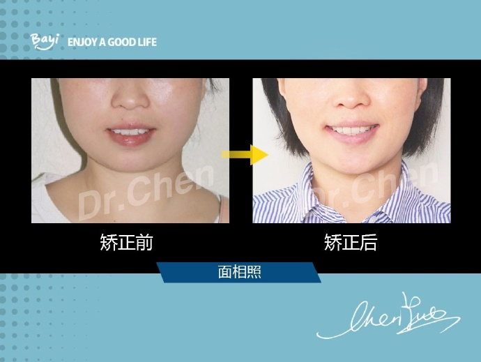 重庆牙齿矫正对女孩子来说牙齿前突是什么感受