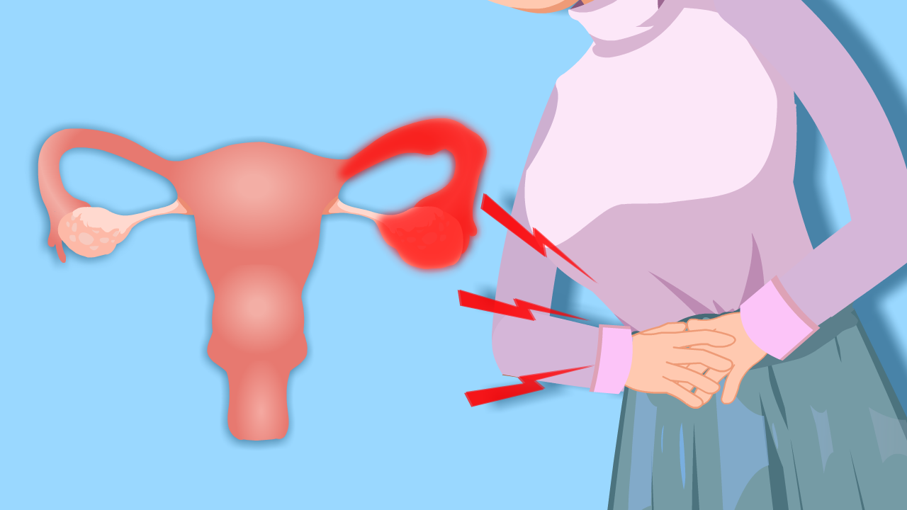 盆腔炎/附件炎的腹痛到底是怎样一种感觉?