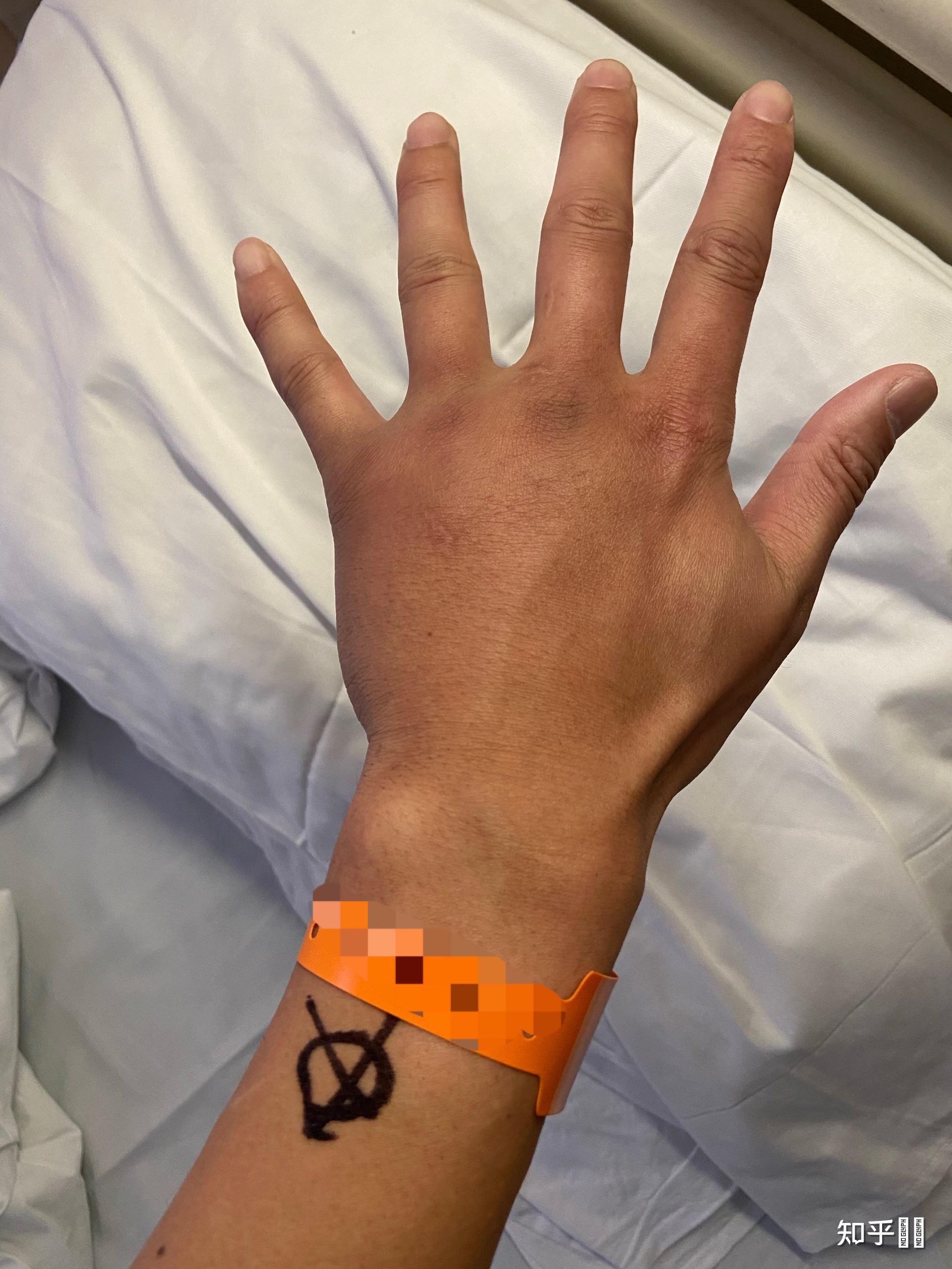 右手第四掌骨骨折保守治疗的第16天,恢复的是否不太理想? - 知乎