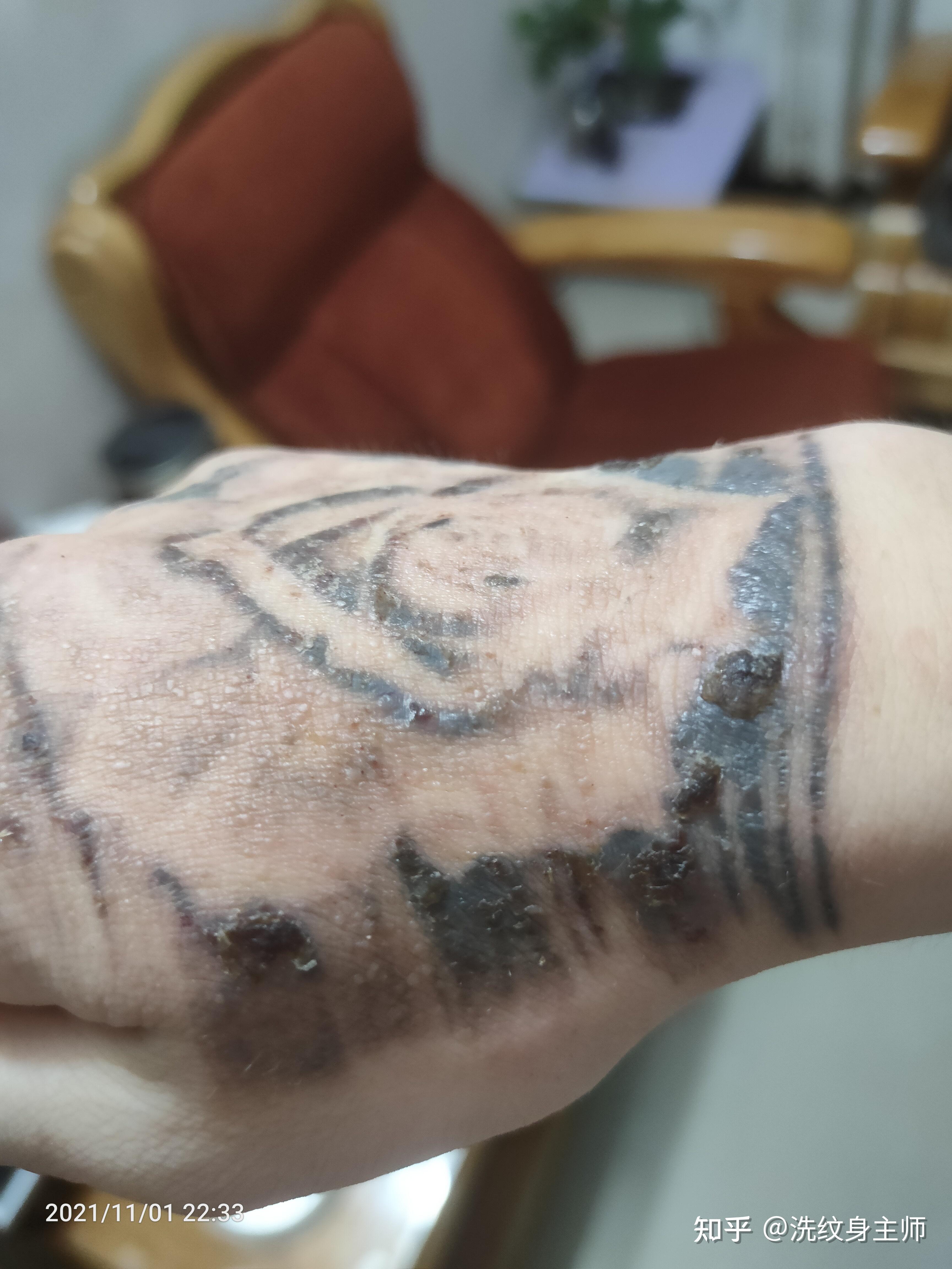 纹身结痂感染图图片