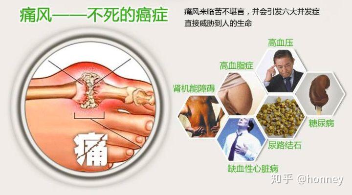 干细胞治疗痛风治疗痛风不止只有药