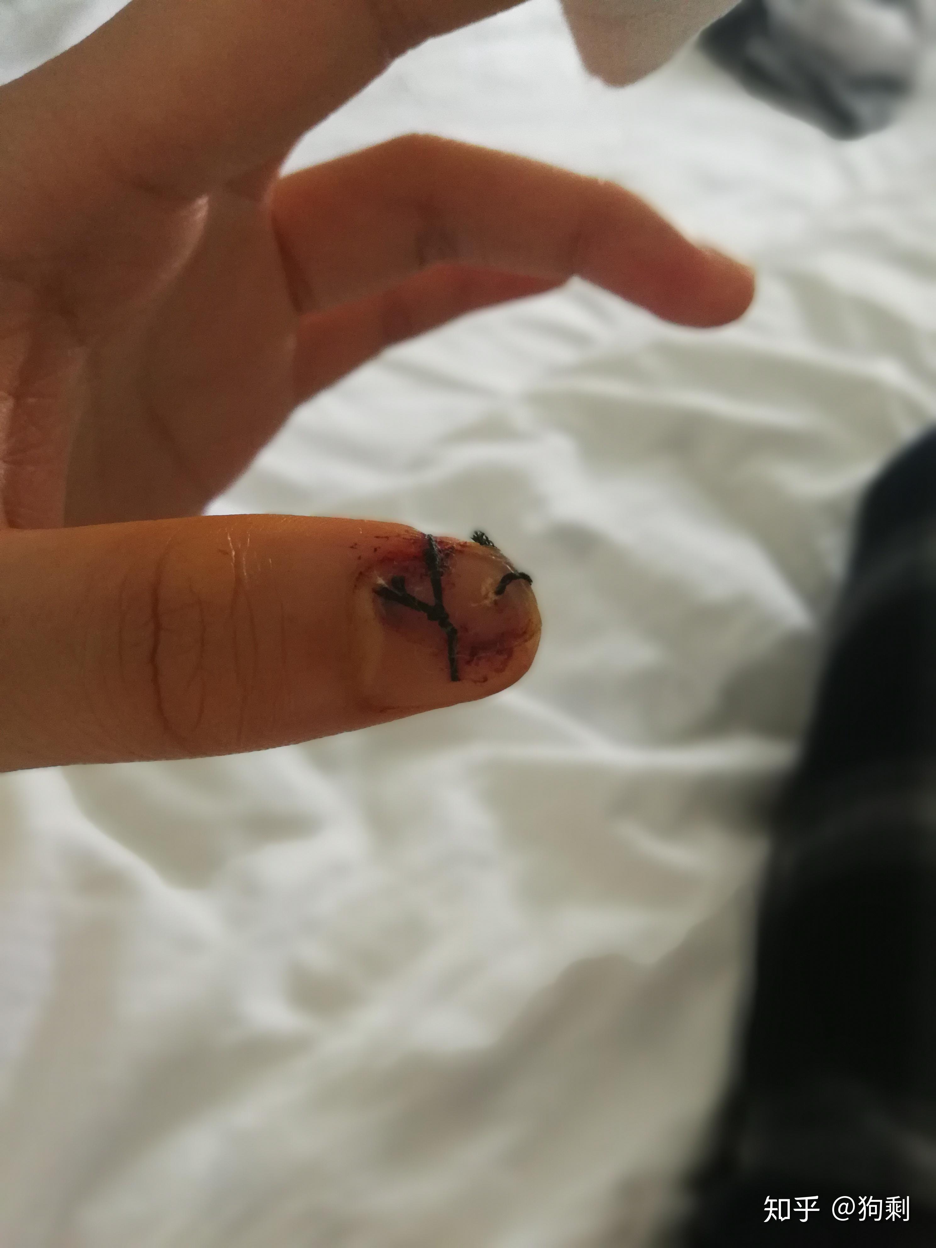 手指被刀削去一块肉,贴回去可以长好么? - 知乎