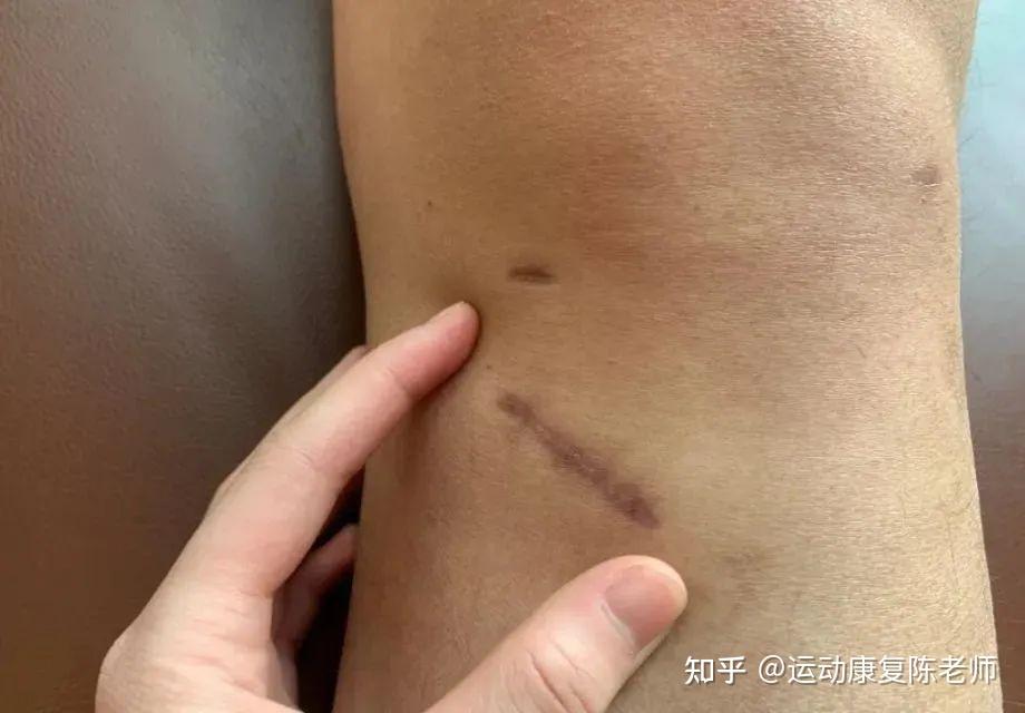 各位大神,得了腰背肌筋膜炎已经七个月了,这个病也一直困扰生活与学习