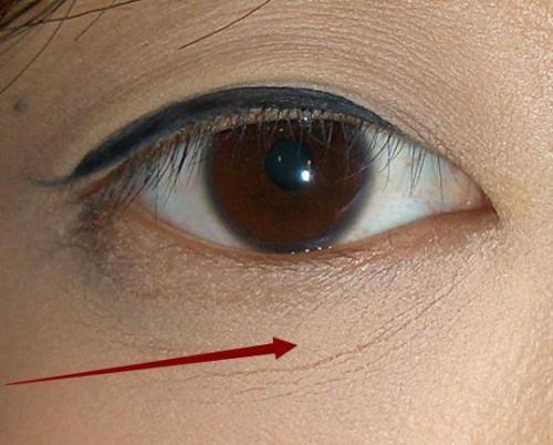 眼部干纹怎么去?如何区分干纹细纹皱纹?