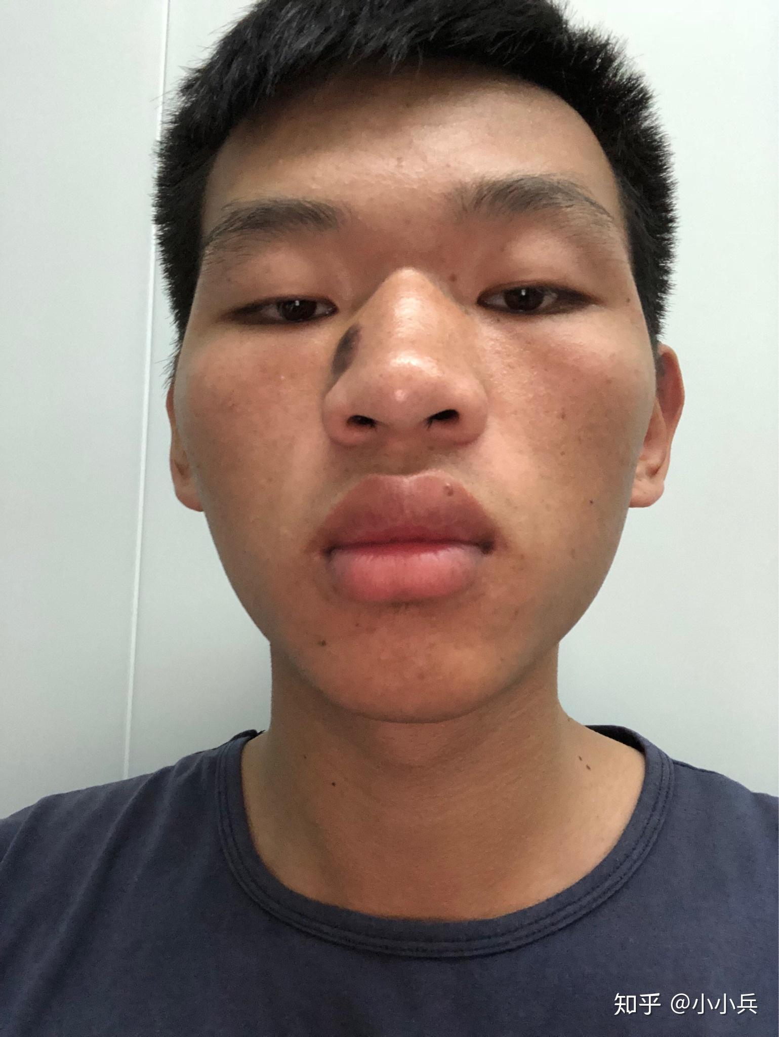 鼻子上有一个特大的黑色素痣,能做掉吗? - 知乎