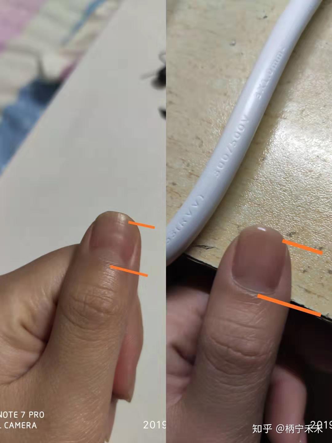 大拇指食指指甲前端无血色,剪指甲的地方与肉分离的比较多_百度知道