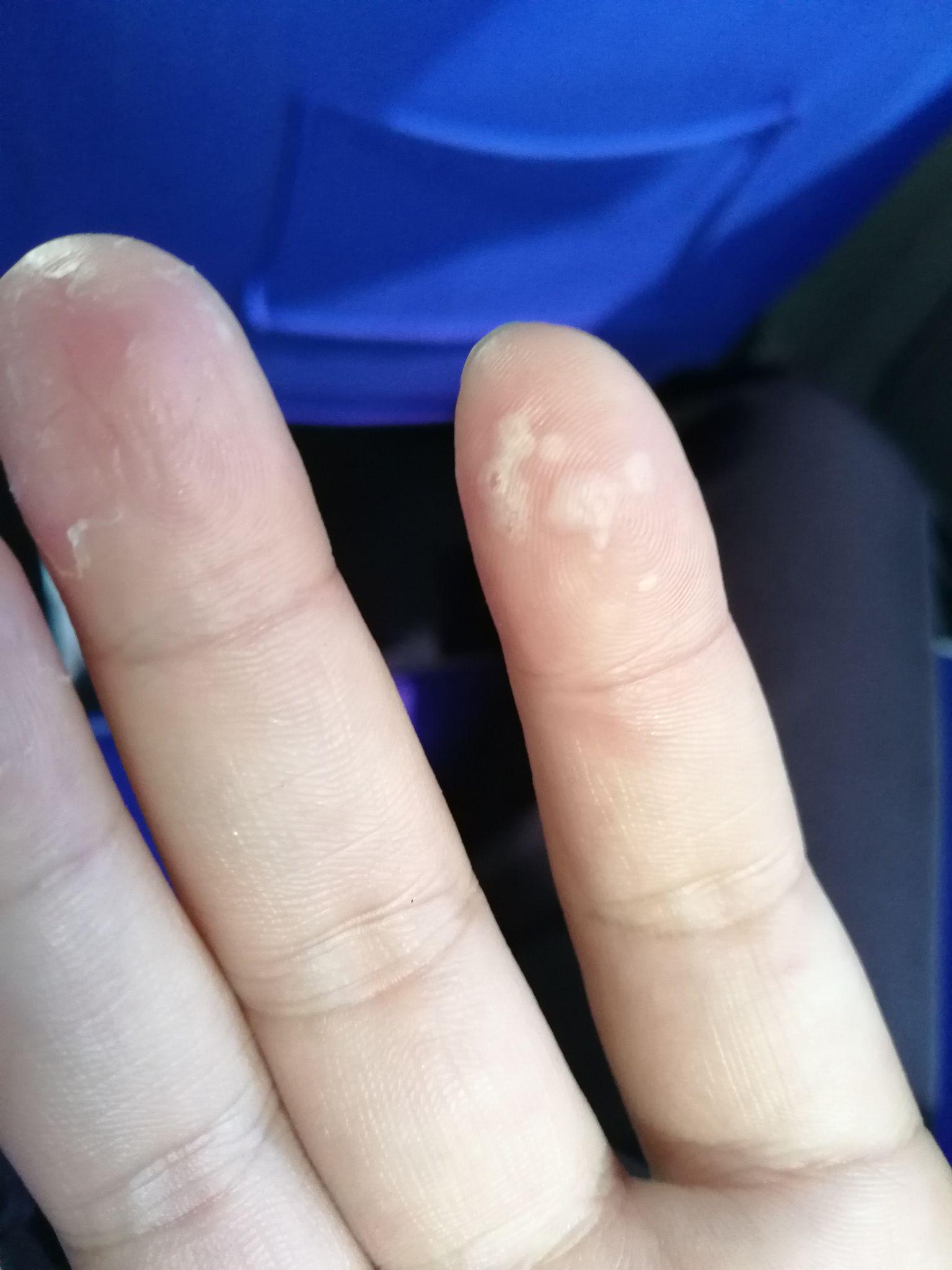 手指脱皮起泡