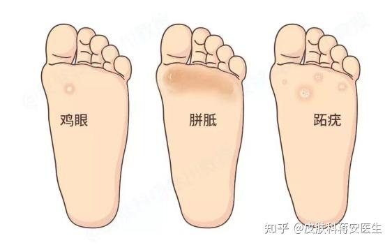 跖疣鸡眼怎么治疗