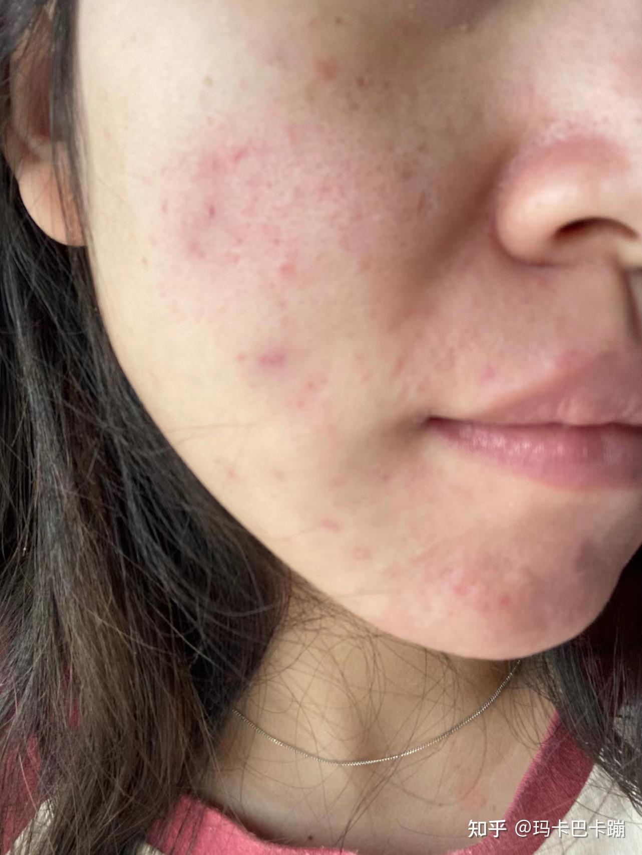 如果你长期长痘,红肿痘,脓包痘,上火痘,姨妈痘,反反复复下不去,可以