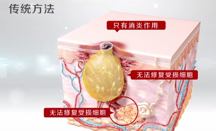 脸上痘痘反反复复怎么调 v2-1f3bec53edb4d3e0387f0f3733a42a1c_r.jpg