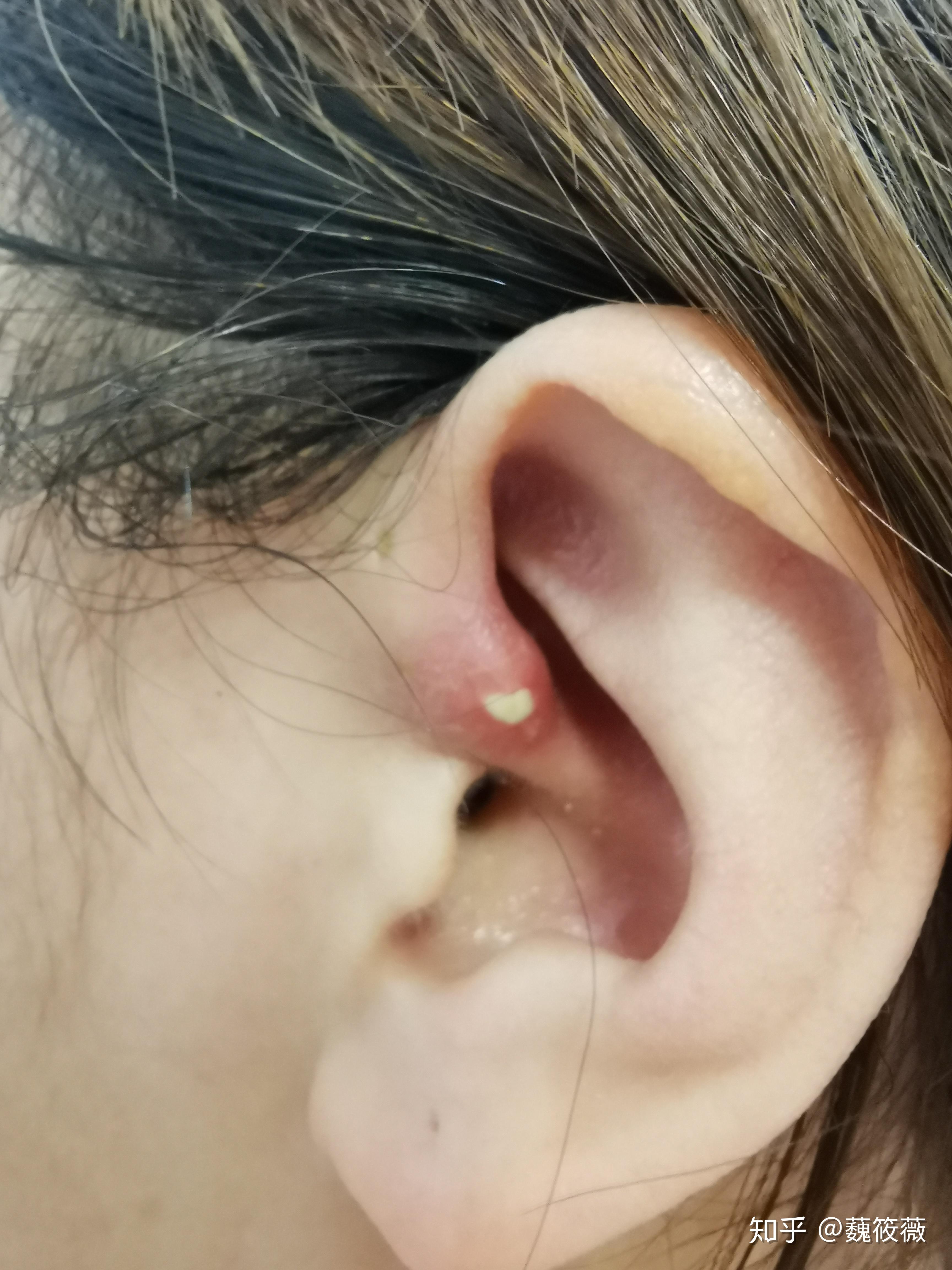 患有先天性耳前瘘管是一种怎样的体验