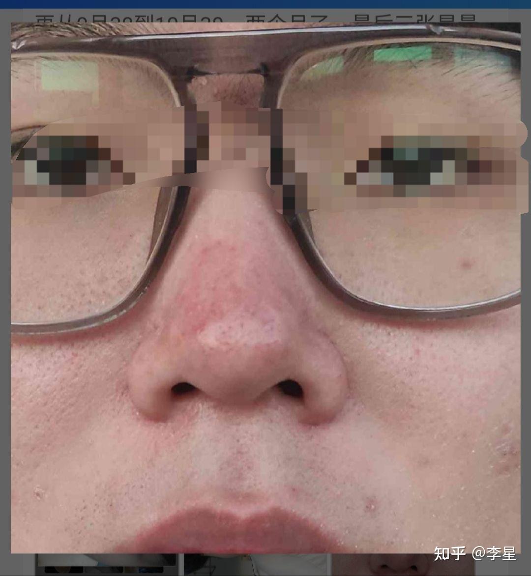 十年酒糟鼻的治疗记录上