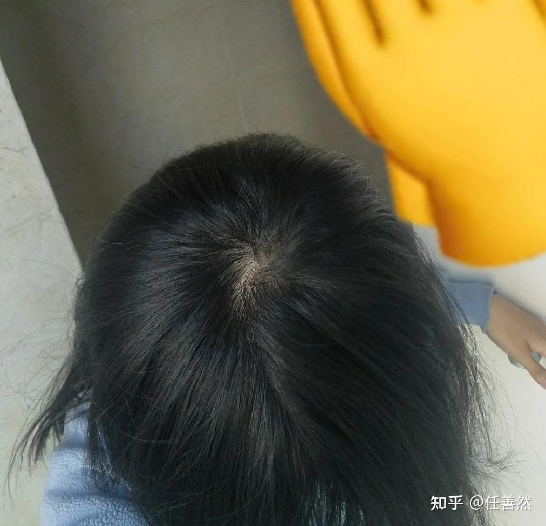 吃什么东西不掉头发呢 v2-1f5be3c115fe3a828f922a47445ada98_r.jpg