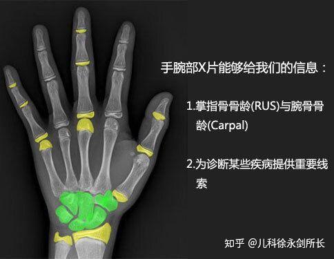 徐永剑所长亲手教你简单识别孩子的骨龄片关注身高警惕早熟