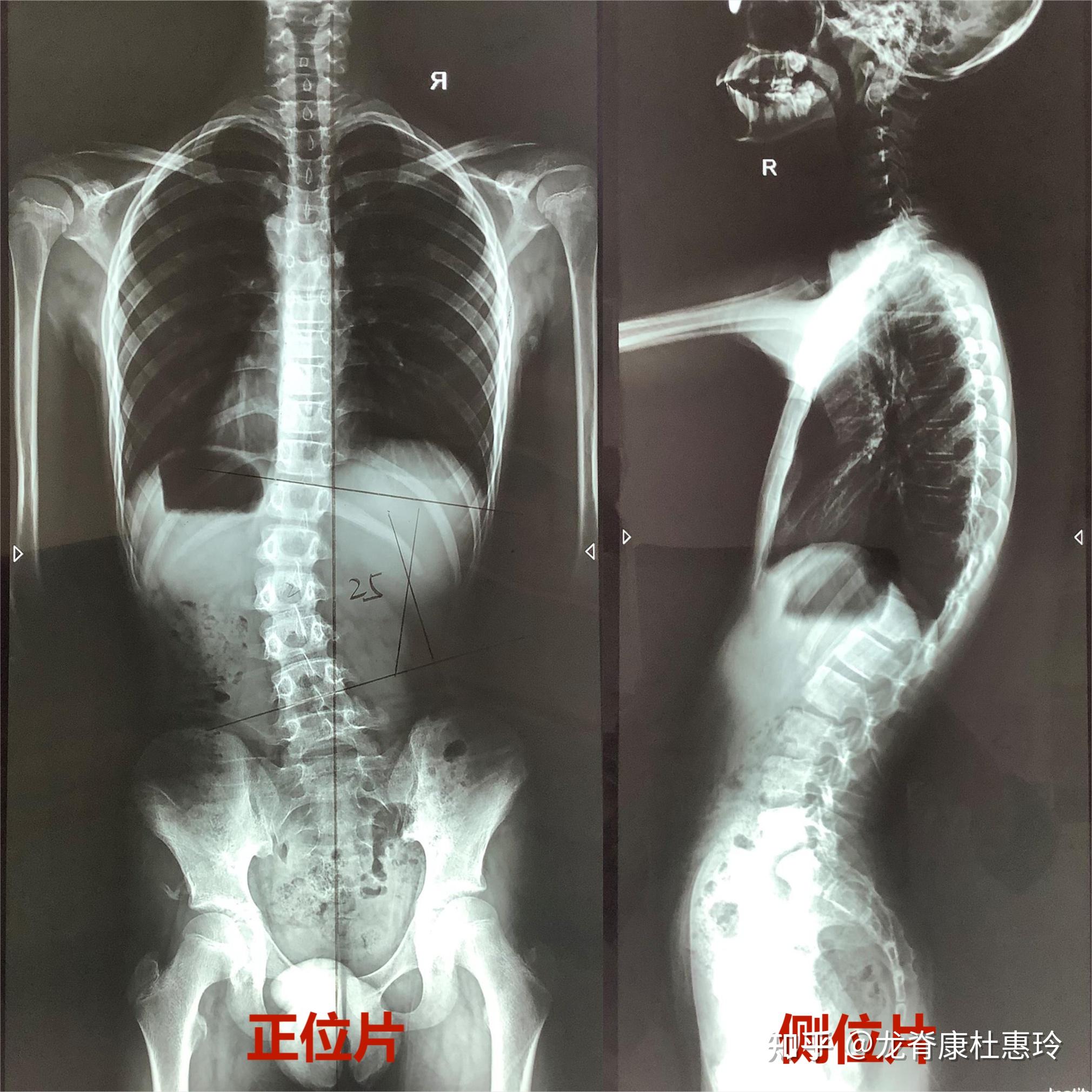 脊柱侧弯拍X光片检查,究竟是“站”着拍还是“躺”着拍? - 知乎