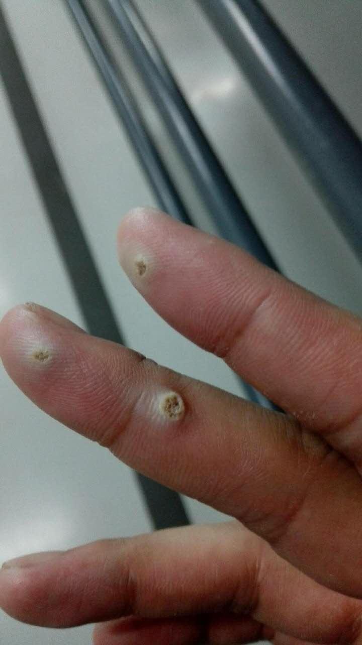 治疗手指上的寻常疣(鱼鳞痣)有什么办法,或者药物? - 知乎