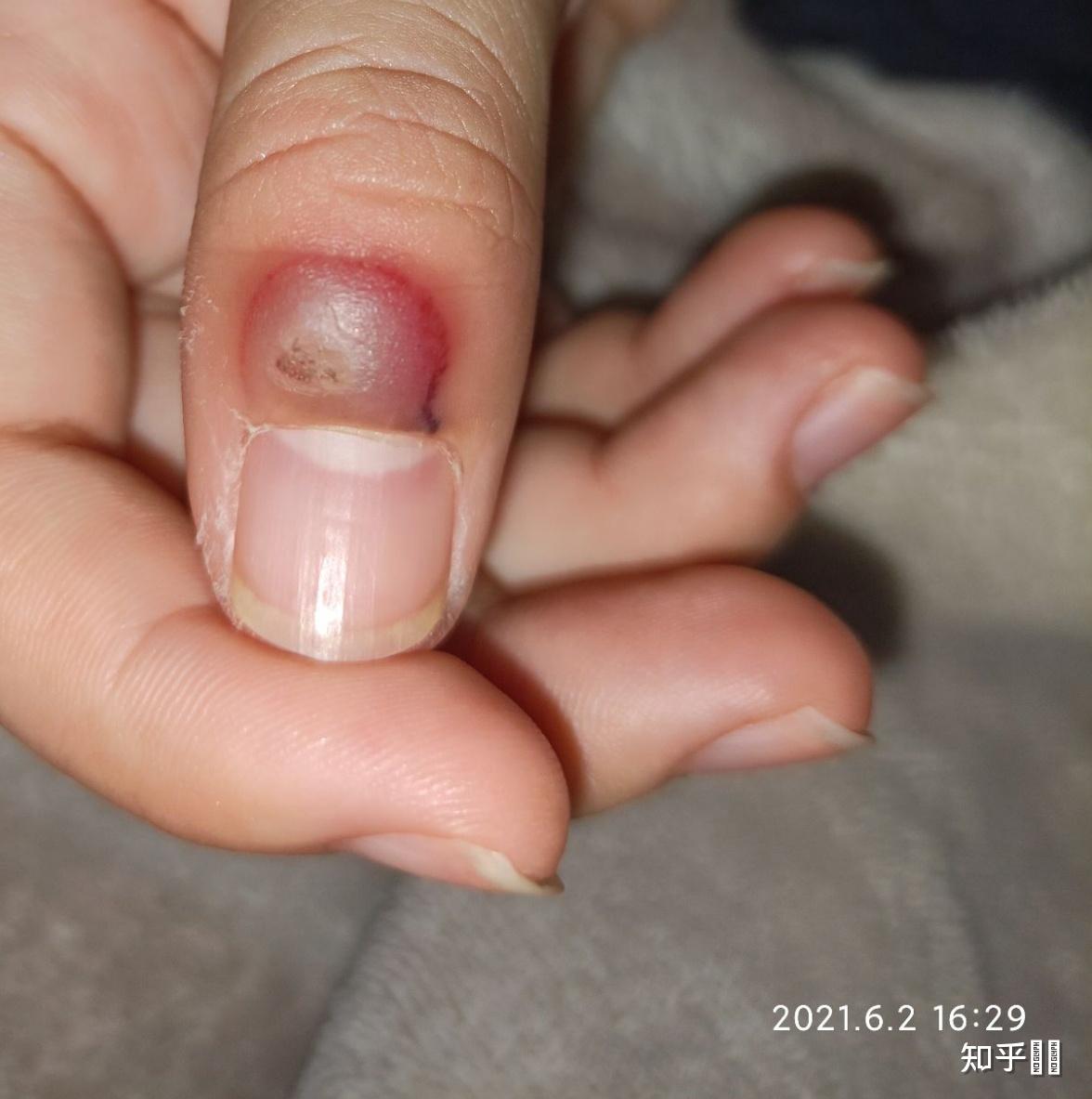 液氮冷冻治疗后手指上出了血泡而且越来越大该怎么办? - 知乎