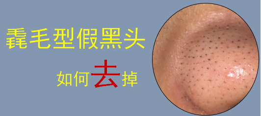 毳毛型假黑头的处理方法 知乎 毳毛型假黑头的处理方法 知乎