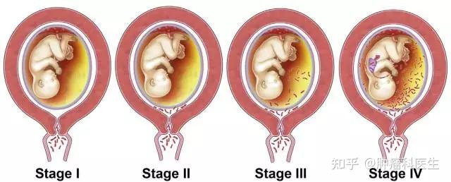 急性绒毛膜羊膜炎是什么引起的?