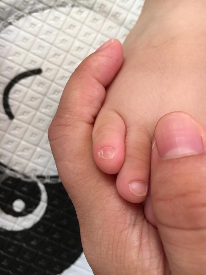 脚的小拇趾趾甲分两半有科学解释吗