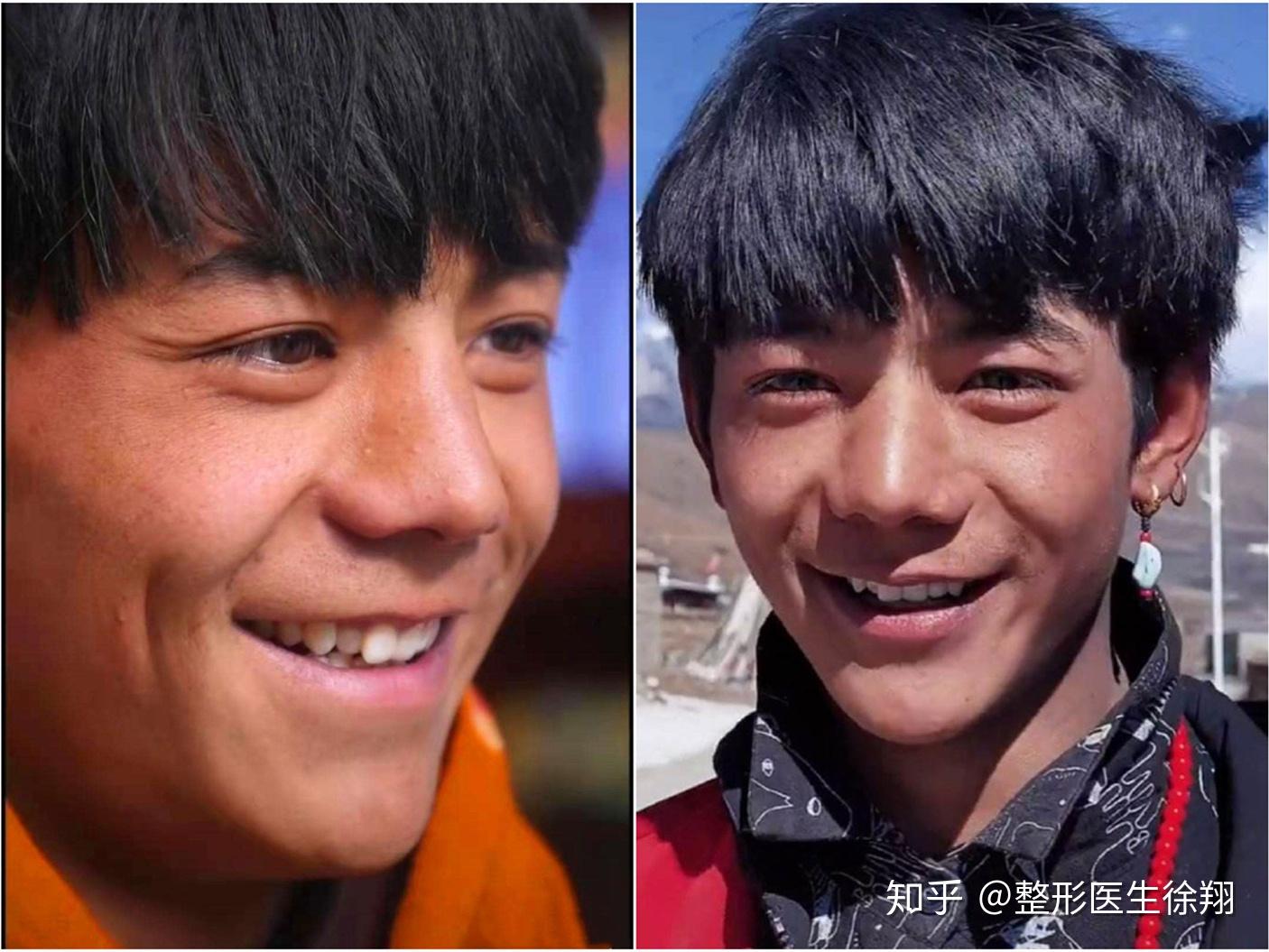 韩国优雅人整形外科——男生鼻子整容模板来了 - 哔哩哔哩