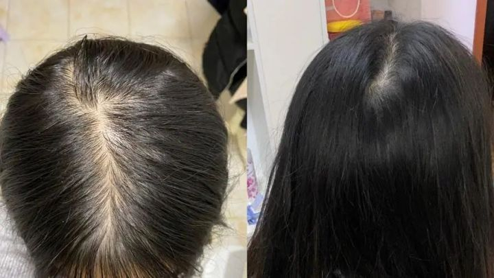 过来人分享脱发治愈全经历!原来生活调节是关键,方法用对碎发蹭蹭往外冒!! - 知乎