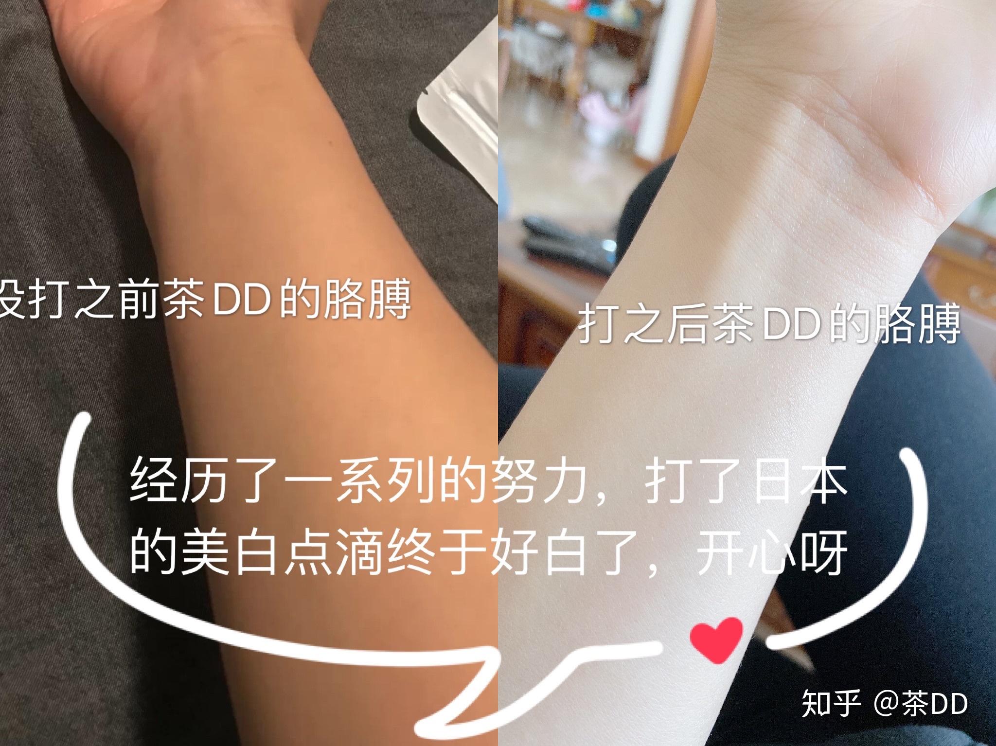 打美白针是一种什么样的体验？效果和副作用如何？ - 知乎