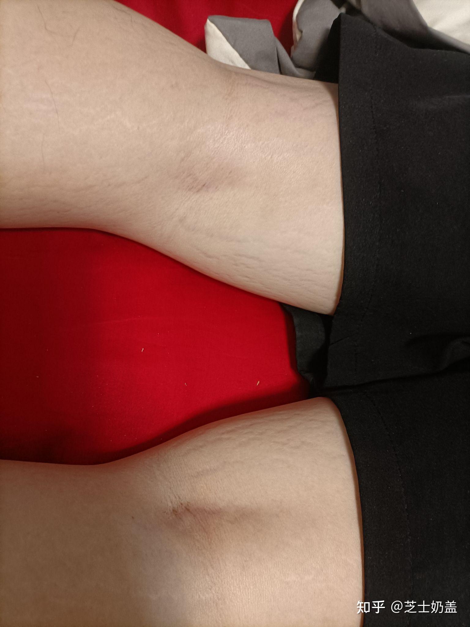 婚前发现老婆大腿上有妊娠纹但她说是因为胖真的吗