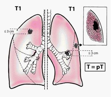 肺癌早 中 晚期怎么分 如何判断肺癌的严重程度 知乎