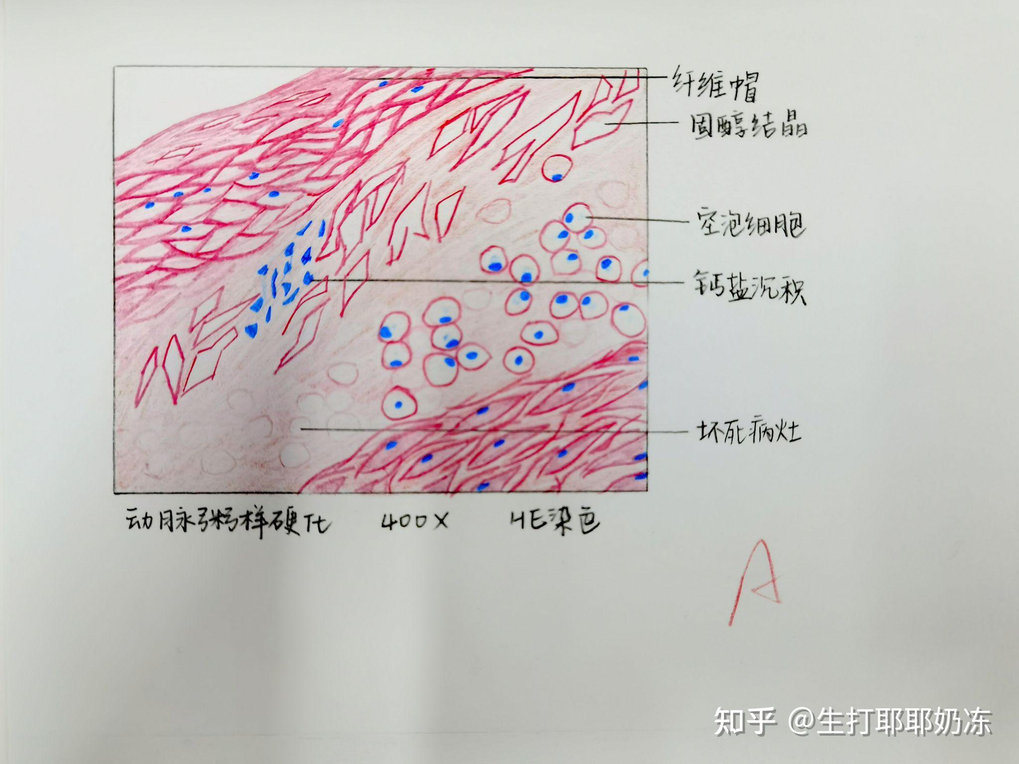 子宫平滑肌瘤手绘图图片