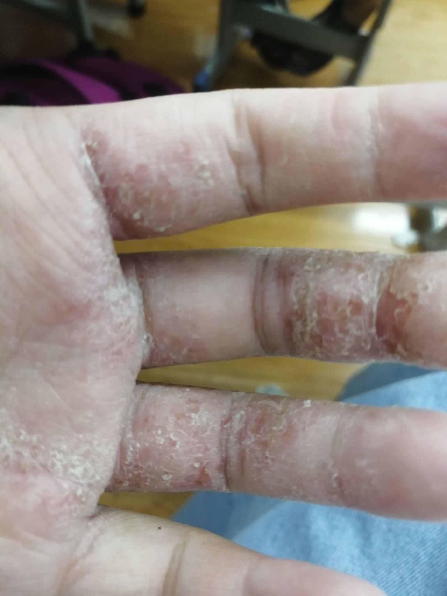 现在也不痒也没有湿疹等症状,也不撕了,用炉甘石和卤米松再试
