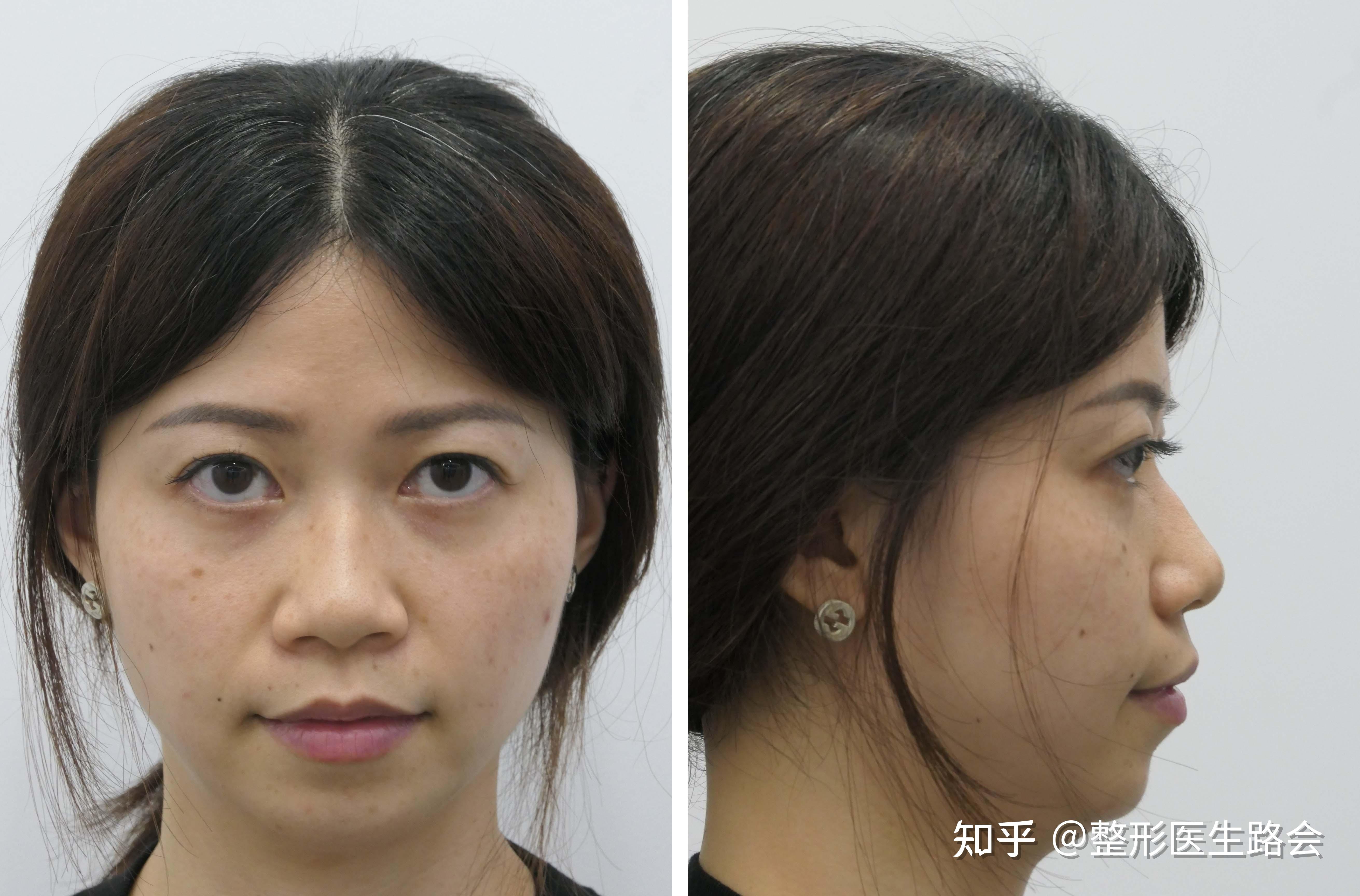 鼻の他院修正（鼻孔縁下降、鼻柱形成、耳介軟骨移植）（症例写真） | 銀座マイアミ美容外科