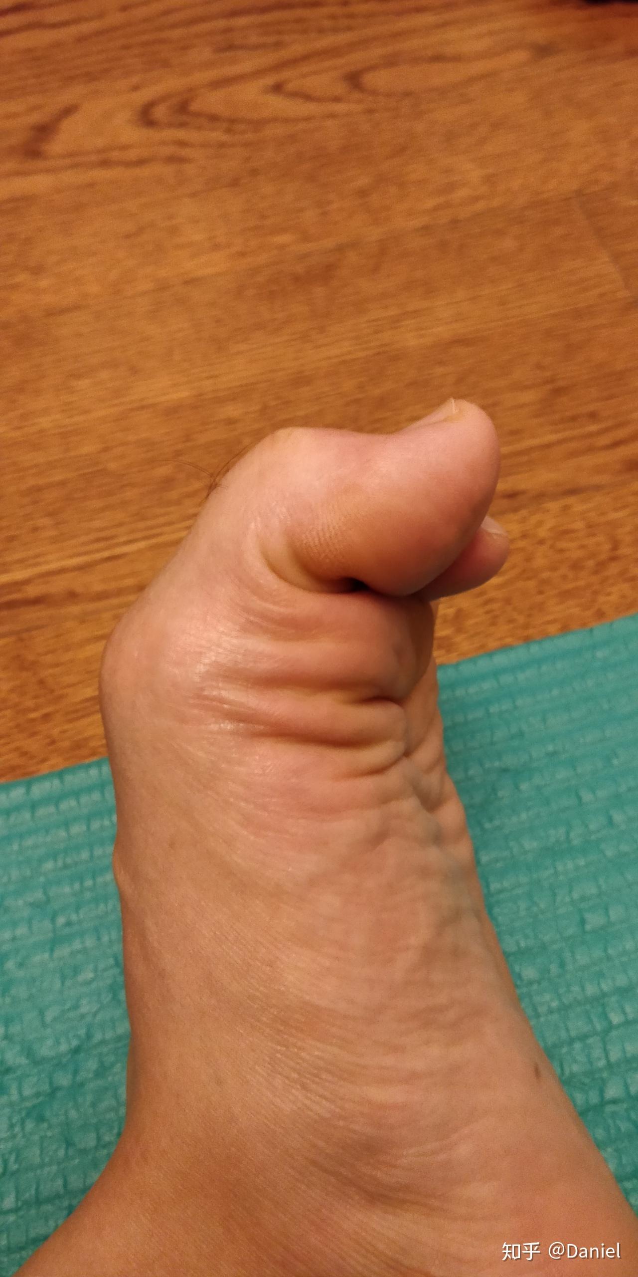 脚的大拇指真的会顶破鞋面吗