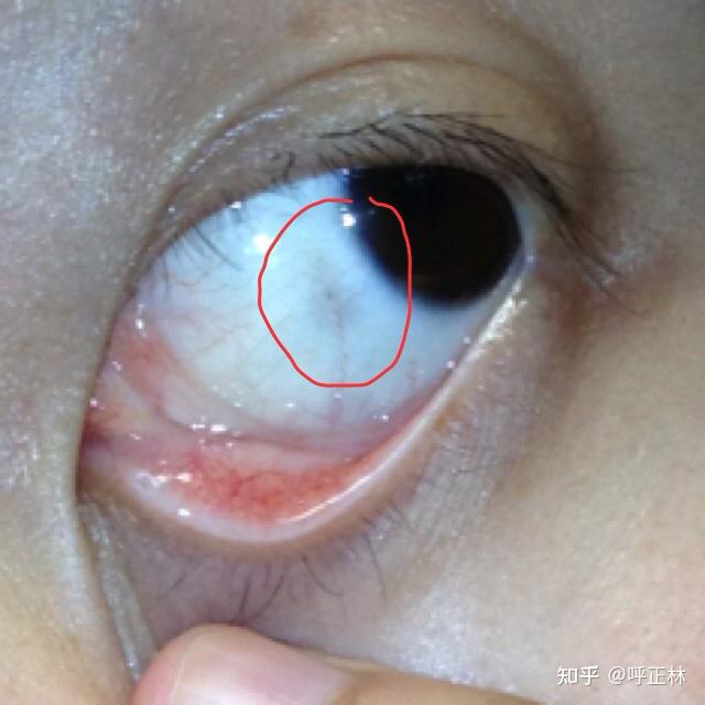 眼睛里有黑色的斑点是怎么回事