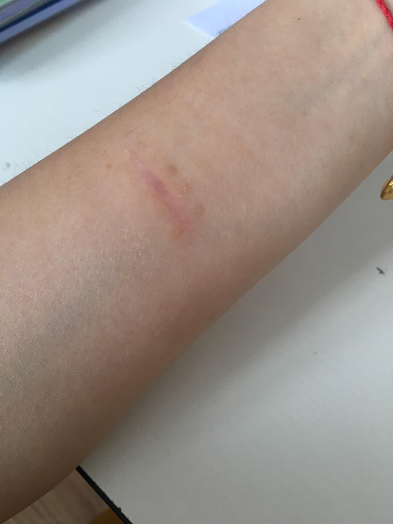 我胳膊有2条疤大概2厘米长,凸出来的,用喜疗疤可以去掉吗?