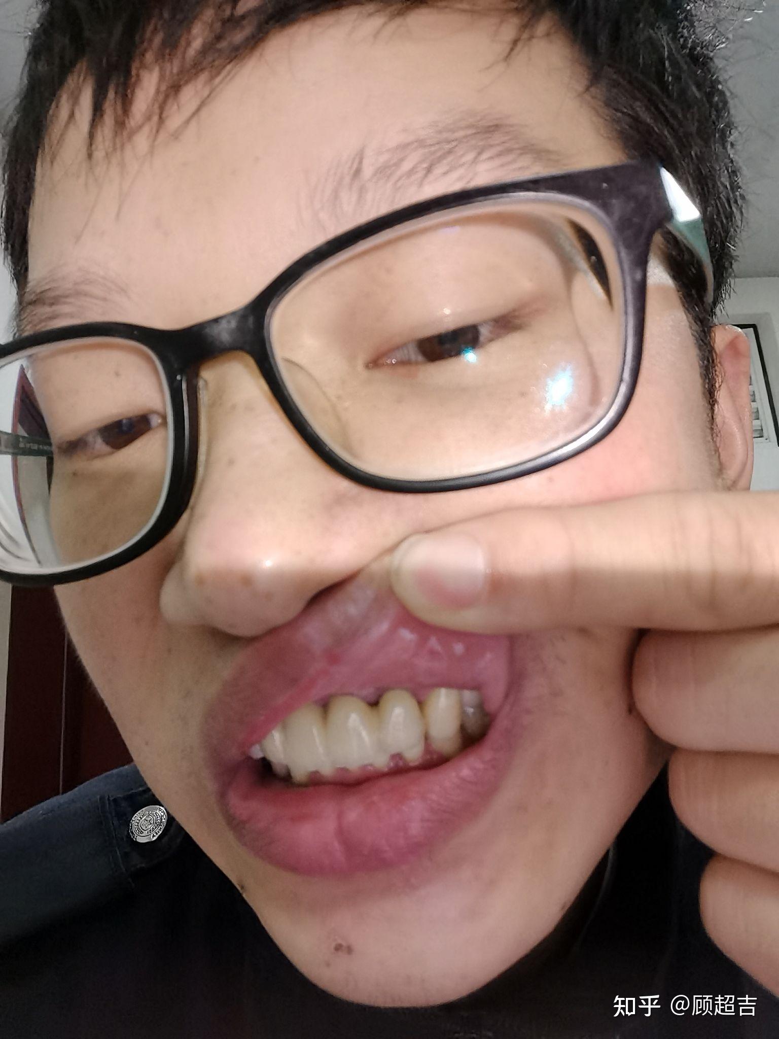 10个月的烤瓷牙造成的牙龈萎缩需要重做吗? - 知乎