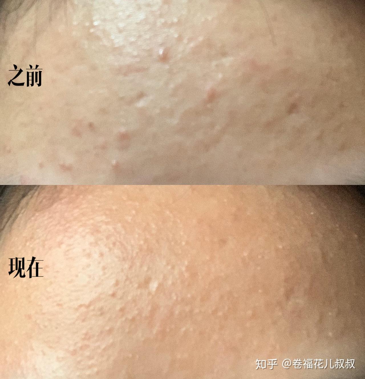 请问脂溢性皮炎都用哪些护肤品? - 知乎