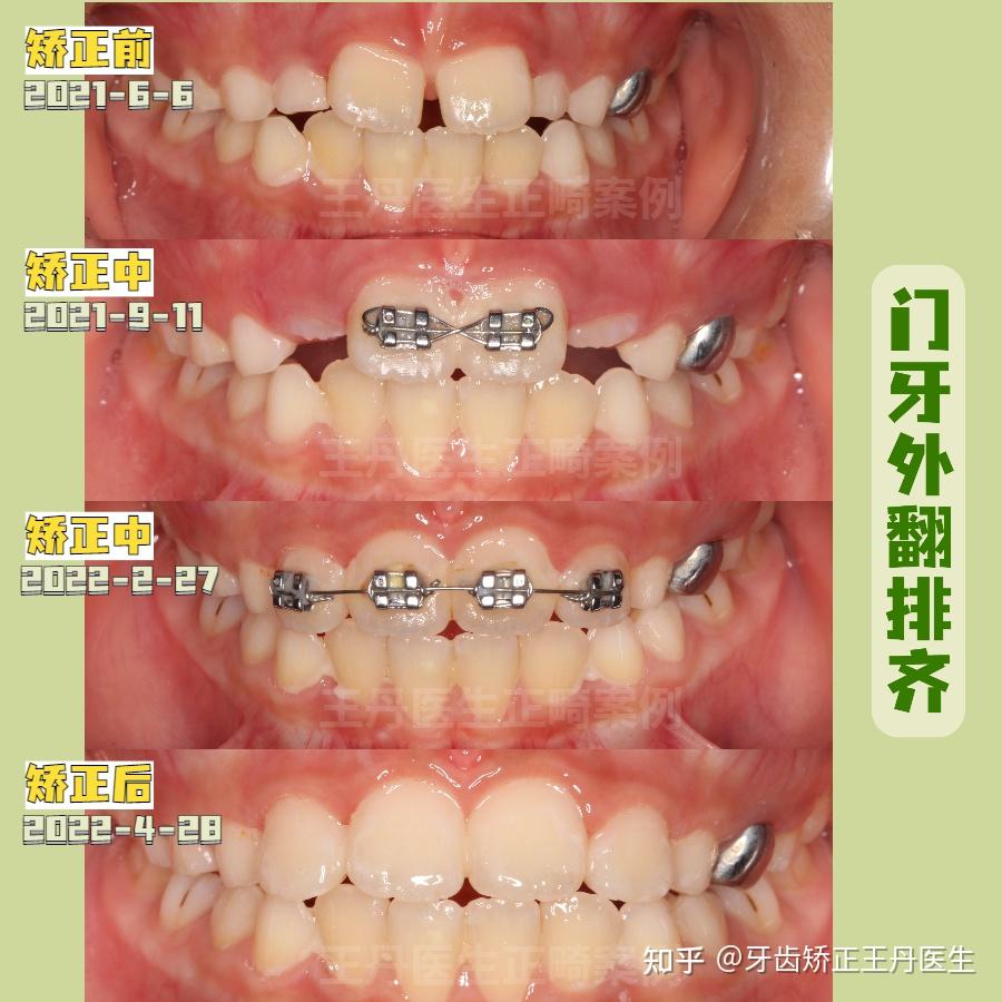 正畸nance弓图片图片