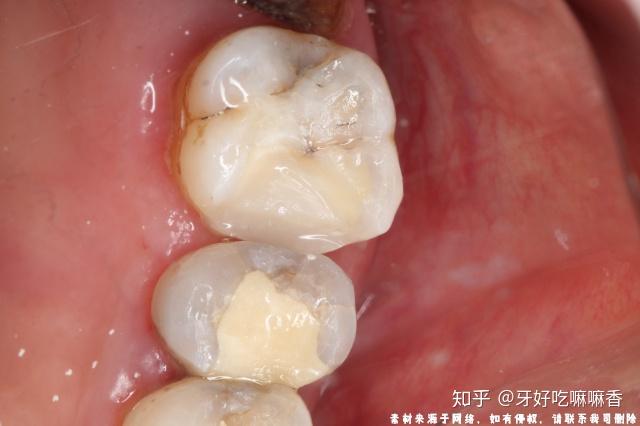 补牙后出现牙疼的情况是正常的吗?
