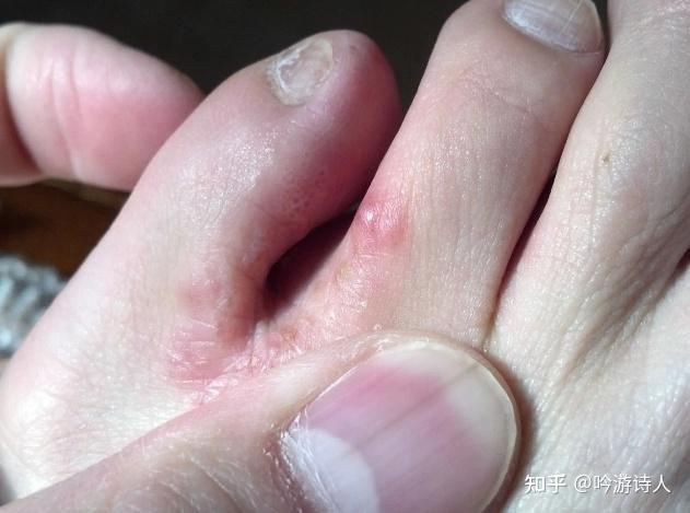 脚上起水泡很痒怎么办?如何好得快? - 知乎