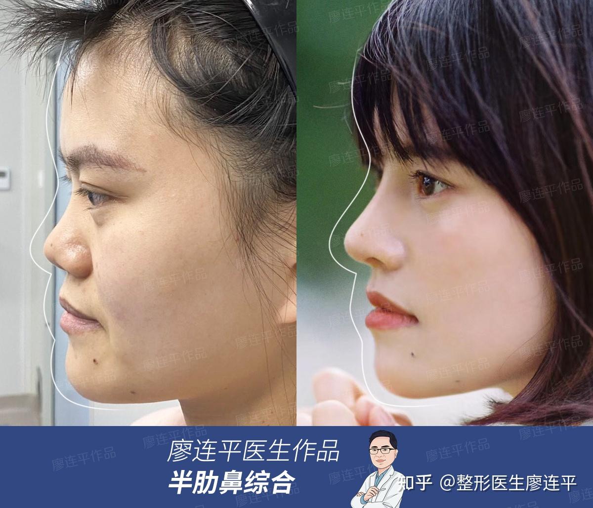在韩国TS找李相均做完下巴矫正，"月亮脸"蜕变为甜美女孩!,颌面对比照-8682赴韩整形网