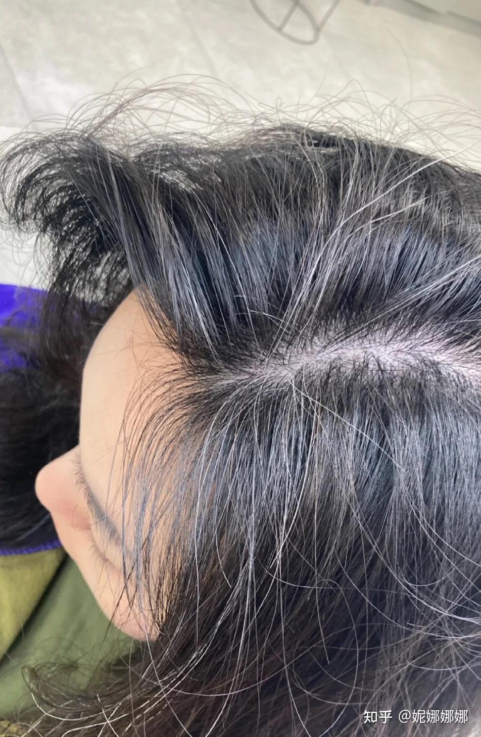 产后脱发真的很严重,都快被搞疯了,有没有不染发就能解决的方法?