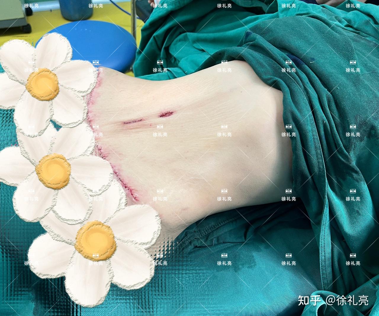 腹直肌分离能否恢复?如何恢复? - 知乎