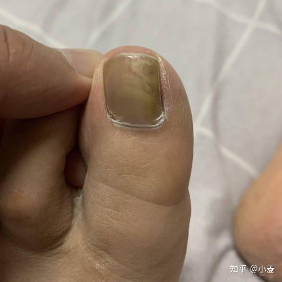 1,指甲变色灰指甲患者在患病初期的时候,灰指甲先从指甲根部开始,然后