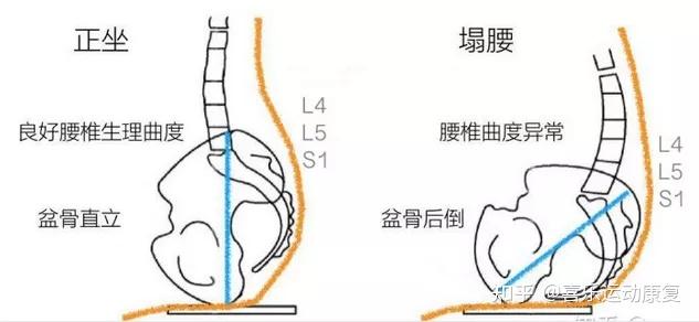 久坐一族怎樣才能緩解腰椎疼痛