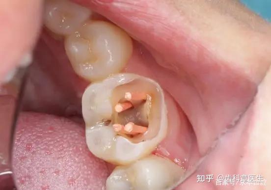 根管治疗杀牙神经痛不痛