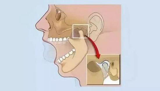 关节弹响,下颚疼痛?家里自检用这几招