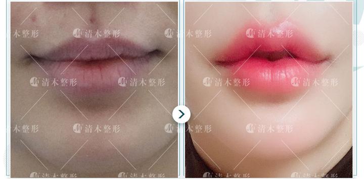 什么是唇珠?【案例分享】 - 知乎