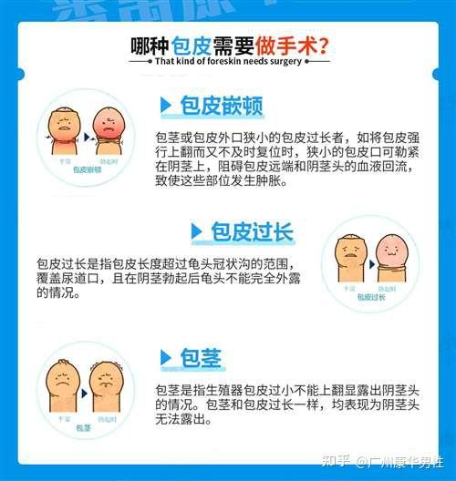 割包皮的好处有哪些?番禺男科科普 - 知乎