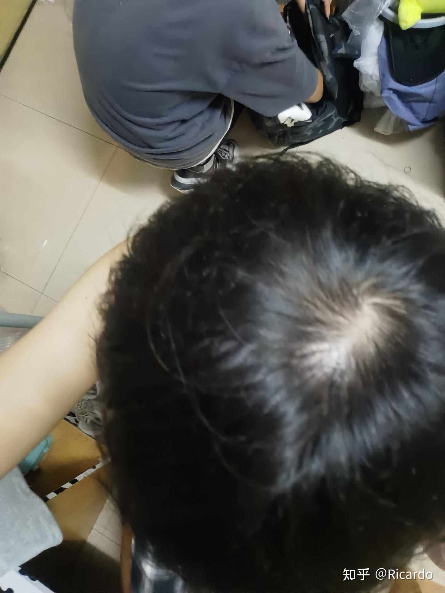 头旋处脱发怎么办,我睡眠质量不好,也容易熬夜,导致头旋处头发稀少,还能养回来吗 - 知乎